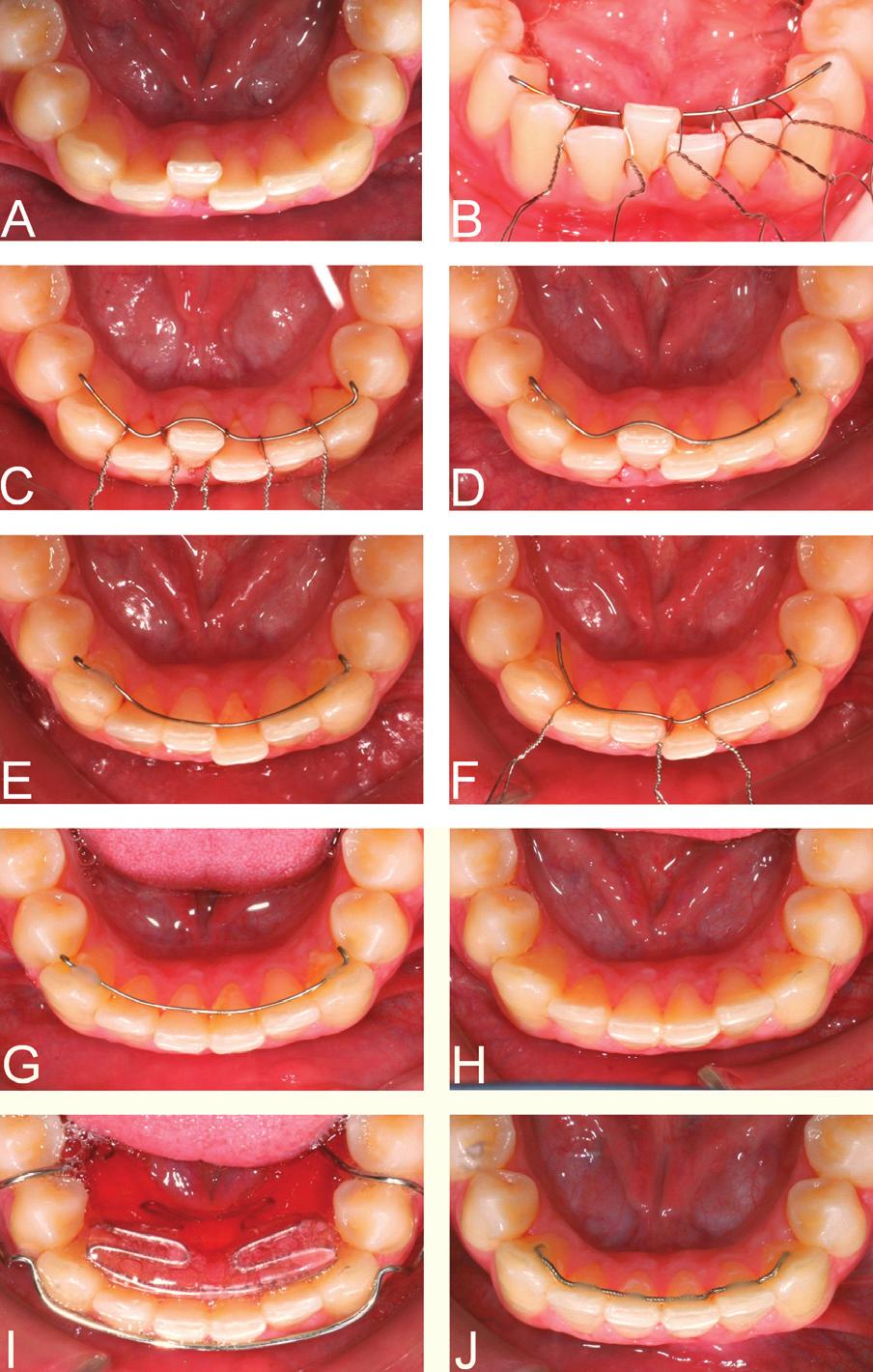 in specific simple cases when there is no opportunity or need for conventional lingual or labial orthodontic treatment.