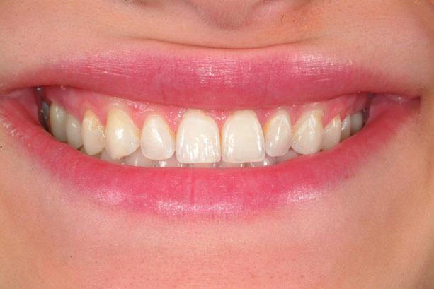 FIGURE 30. The smile arc was enhanced by tipping the curvature of the anterior sweep of the maxillary teeth to better match the curvature of the lower lip. FIGURE 31.
