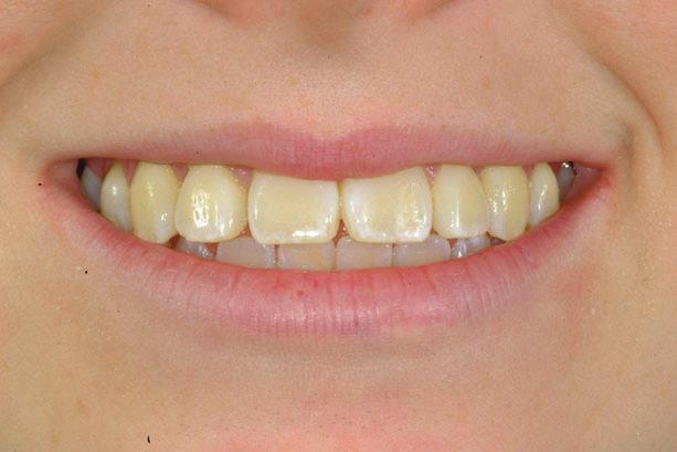 The close-up smile evaluation demonstrated proclined (flared) maxillary incisors, incomplete incisor display on smile, and a flat smile arc.