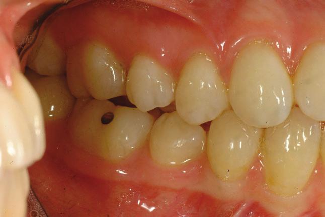 The close-up frontal and oblique smile picture permits scrutiny of incisor angulation, incisor display and smile arc characteristics (Figure 5).