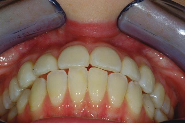 FIGURE 8. 4 mm of overjet was present. The lower incisors were actually in contact with the cingulae and marginal ridges of the maxillary incisors, an obstacle to orthodontic retraction. FIGURE 9.