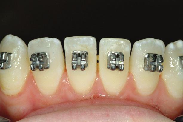 Because the lower incisors were in close proximity to the cingulae of the upper incisors, overjet reduction was going to be limited by how much space was available for retraction.