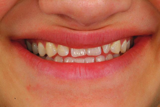 She was referred by her dentist for evaluation of her smile esthetic presentation (Figure 21) with spacing present and lack of tooth display on smile.