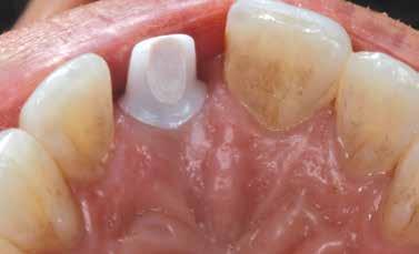 Although limitations were apparent, improvements in implant and prosthetic design enabled the fabrication of implant crowns that could be placed predictably, with confidence in the long-term success