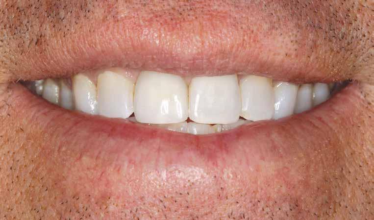 Optimizing Anterior Esthetics with the Inclusive Tooth Replacement System Figure 26: The patient was thrilled with the final implant restoration in the esthetic zone.