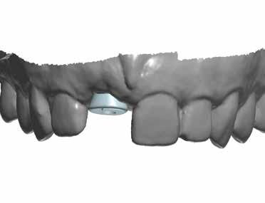 Optimizing Anterior Esthetics with the Inclusive Tooth