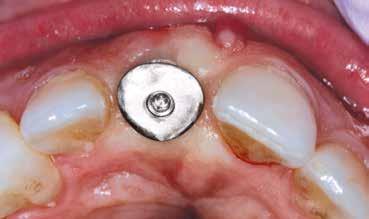 The patient wore a partial removable appliance until the final impression appointment.