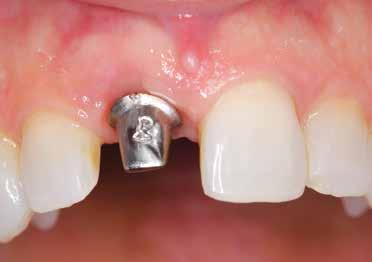 Optimizing Anterior Esthetics with the Inclusive Tooth Replacement