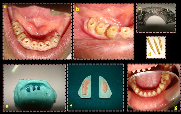 Figure 2: Multiple post space preparations in mandibular arch (a,b), modified stock partial edentulous tray and tooth pick (c,d), pick up impression of post space using tooth pick lined with inlay