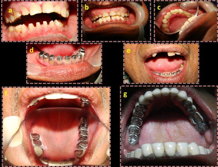 Figure 3: Temporary build up of mandibular and maxillary teeth followed by temporization (a to c), cemented cast post core foundation restorations (d,e), cemented maxillary crowns and fixed partial