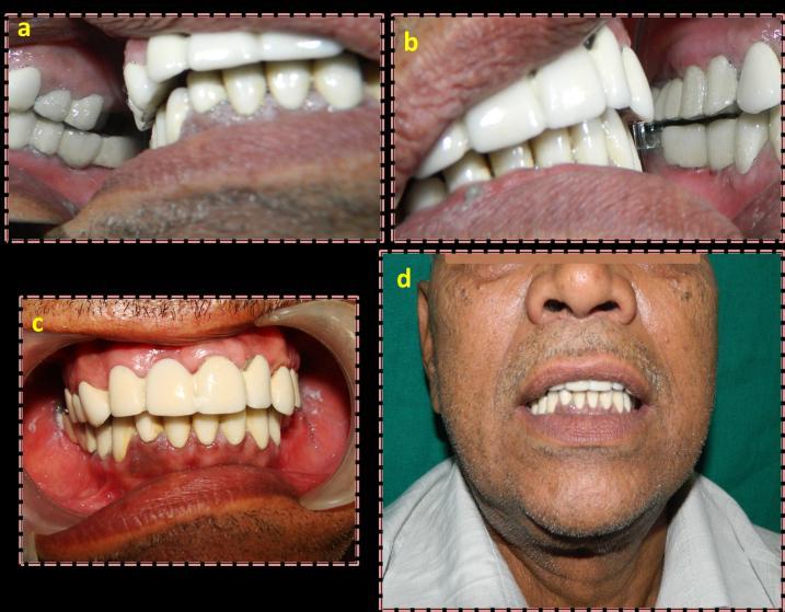 Figure 4: Intra oral view showing right and left side occlusion (a,b), frontal view during trial cementation (c) and completed occlusal rehabilitation (d) Discussion For any foundation restoration of