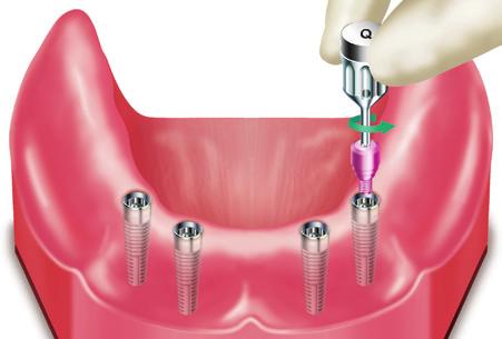 LOCATOR Abutment System Chairside Placement of the LOCATOR Abutment New Denture CLINICAL SECTION Abutment Selection Measure the tissue thickness from the top of the prosthetic table of the implant to