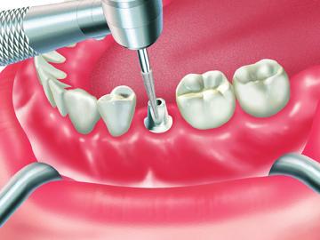 Restorative Options Restorative Options Cement-Retained Restorations Cement-retained implant restorations are very similar to traditional crown and bridge restorations.