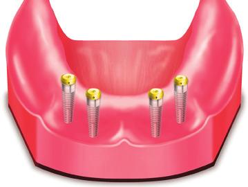 Restorative Options Restorative Options Implant Overdenture Restoration - Attachment-Retained The denture is retained in the mouth with an attachment mechanism supported by tissue.