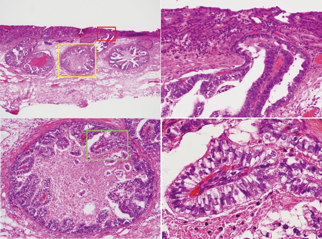 Matsumoto K et al. Gastric cancer with enteroblastic differentiation A B C D Figure 2 Histological examination of the resected specimens with hematoxylin and eosin stain (case 1).