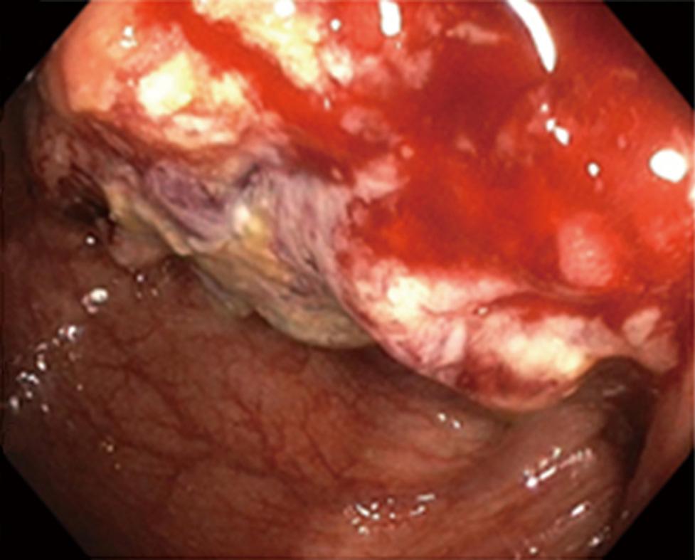 Amebiasis may involve any part of the bowel, but the cecum and the ascending colon are predilection sites [9].