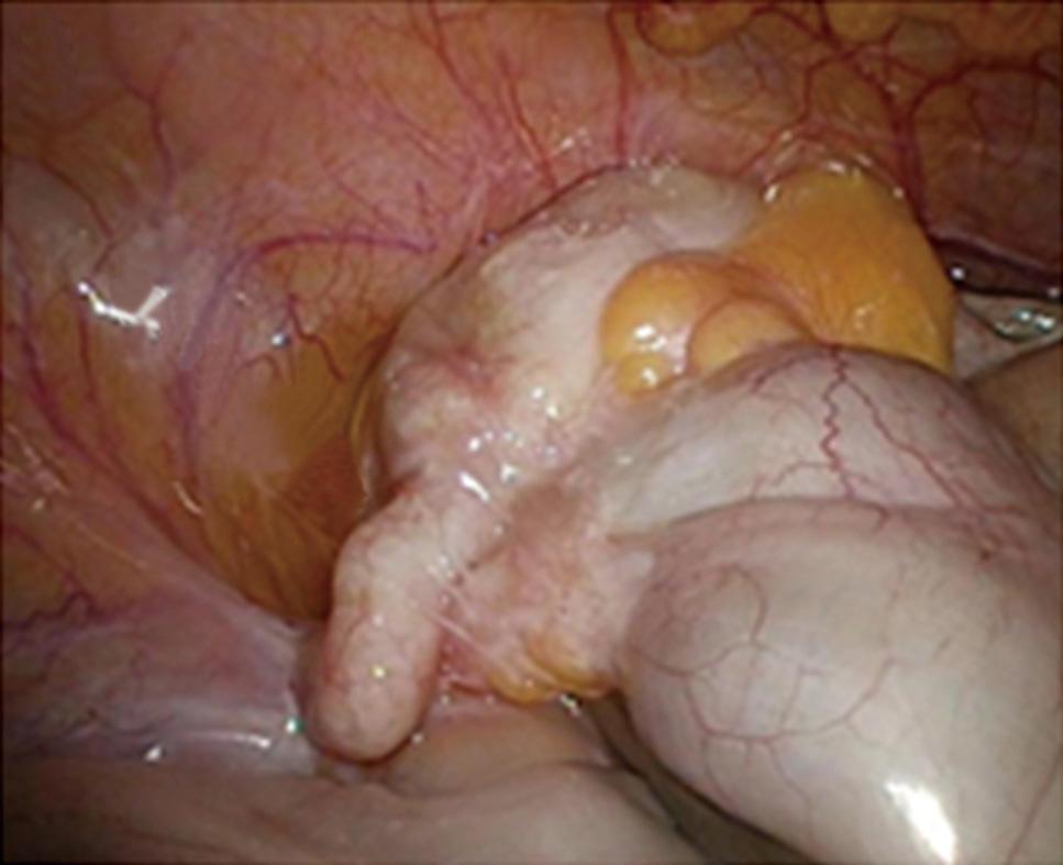Surgical resection was performed after eradication of amebiasis and chemotherapy. B: Gross image of the Douglas-resection showing bilateral ovary metastases (arrows).