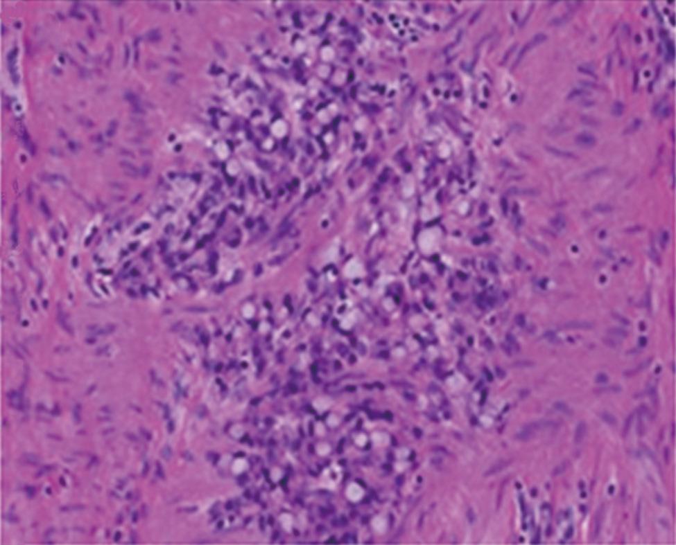 Grosse A. Amebiasis and coexisting colon carcinoma A B C D E F Figure 6 Biopsy-based diagnosis of signet-ring cell adenocarcinoma was confirmed by histology of the resected specimens.