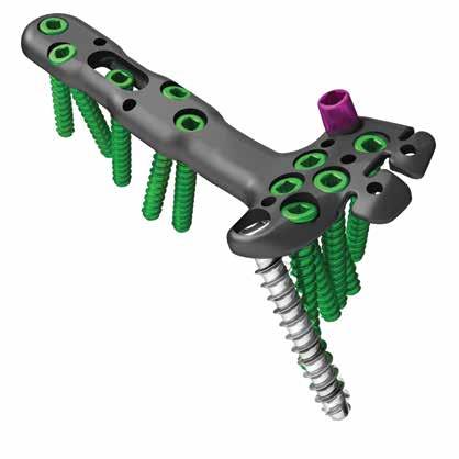 Implant Features Oblong screw hole allows for fine tuning of the plate position. Cross-locking oblique screw options provide additional three-dimensional fixation in comminuted or osteoporotic bone.