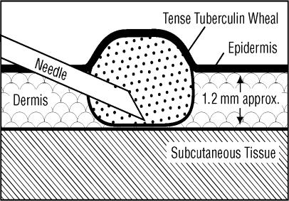 Mantoux Tuberculin Skin Test (TST) Standard (old) method of skin testing for M.