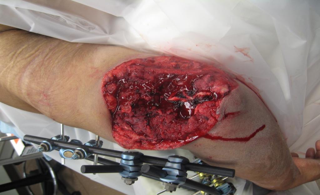 Wound Preparation for
