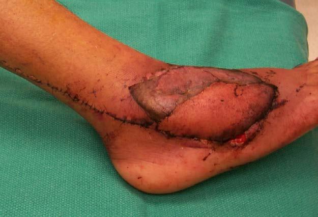 fasciocutaneous offers technical advantages such as easy dissection with preservation of more important vascular structures in limb, complete coverage of soft tissue