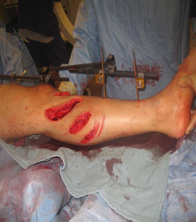 Wound Colonization Initial colonization of traumatic wound Increases with time Need to
