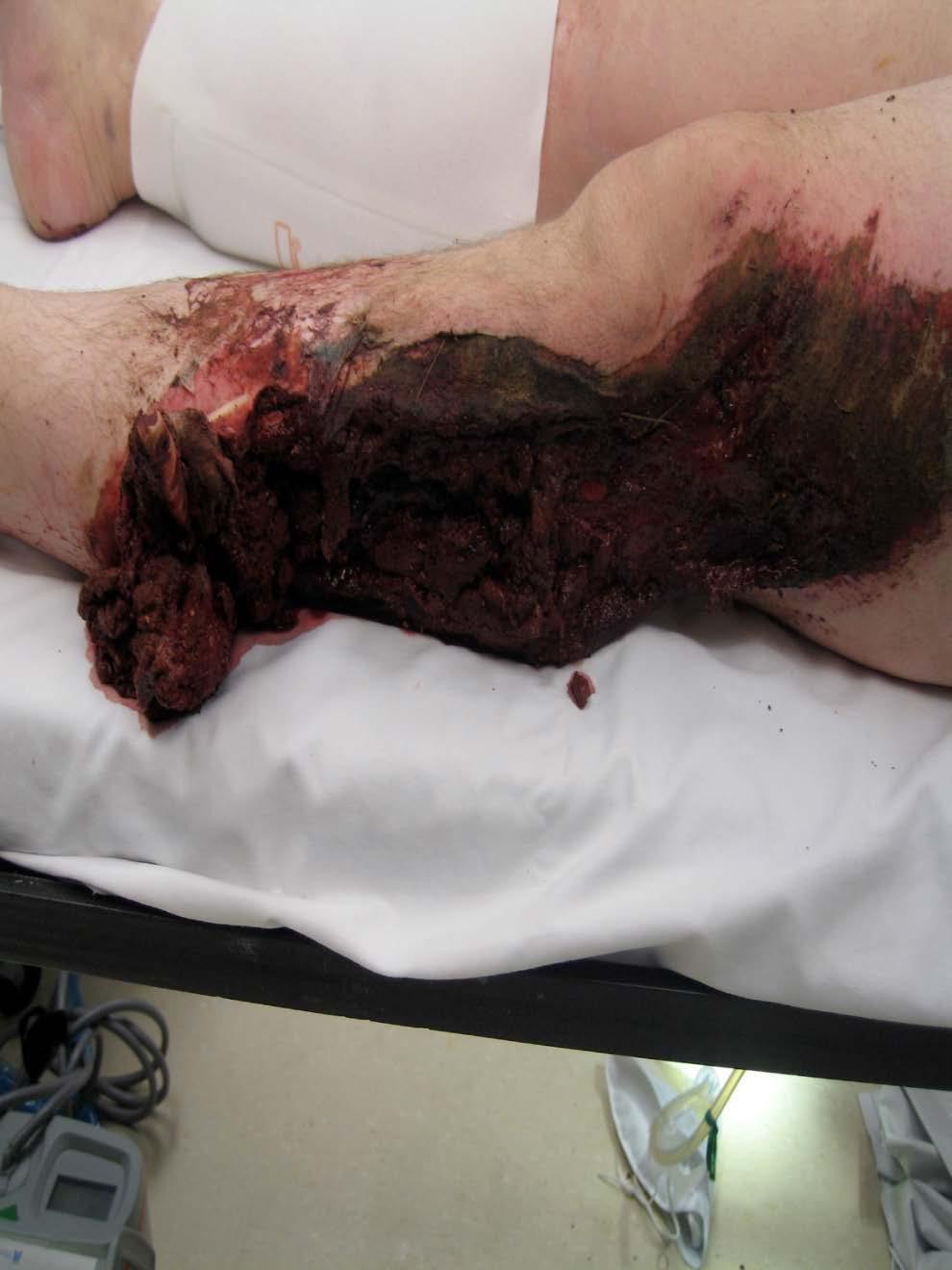 Wound Excision- Debridement Conversion of traumatic wound to a surgical wound with debridement of all devitalized tissue skin, fascia, and bone Unless gross contamination, evidence unclear as to best