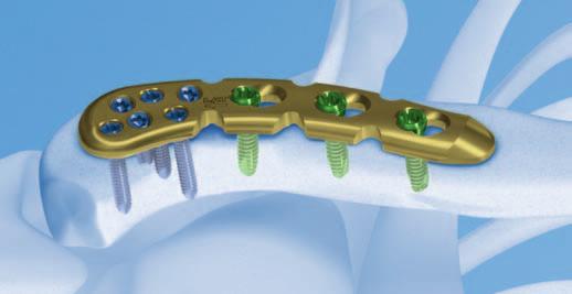 clavicle. Features and Benefits LCP Superior Clavicle Plate with lateral extension Shaft holes 3.