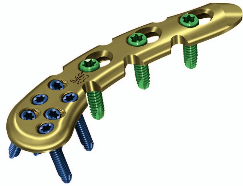 4 mm cortex screws Recon plate segments allow any necessary plate contouring Undercuts reduce