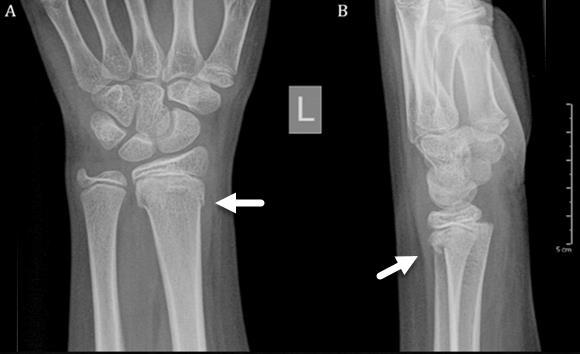 FIGURES Figure 1: 13-year-old male with post-traumatic osseous cystic lesion following a distal radial fracture.