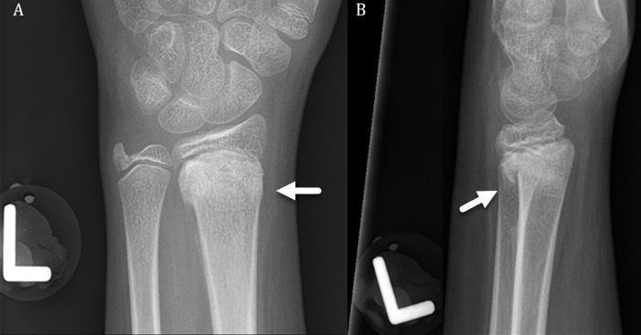 mild dorsal displacement of the radial epiphysis suggestive of Salter-Harris Type 2 fracture of the distal radius. TECHNIQUE: Siemens, 45 kvp, 2.