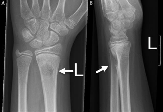 Figure 3: 13-year-old male with post-traumatic osseous cystic lesion following a distal radial fracture.