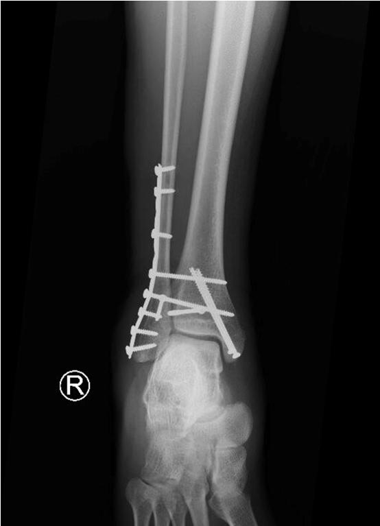 Stable fractures can be treated without surgery Early weight bearing Edema Control