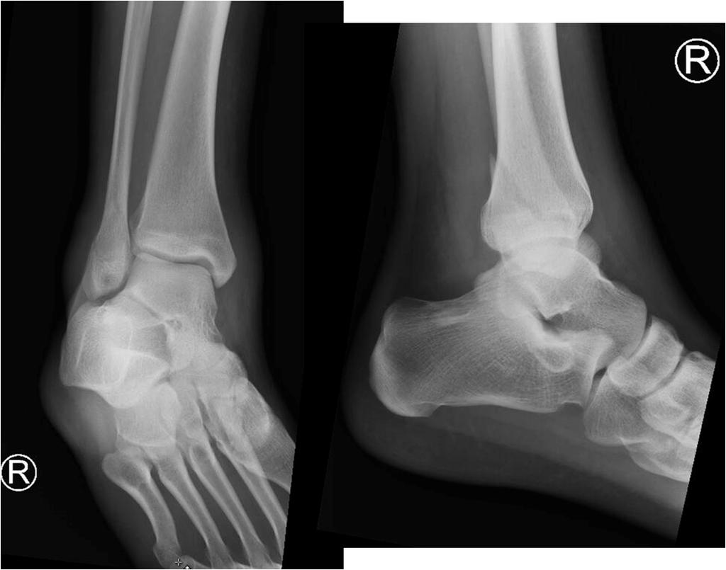 Twisting injury leads to predictable injury pattern Fibula fractures alone can often be treated non-operatively