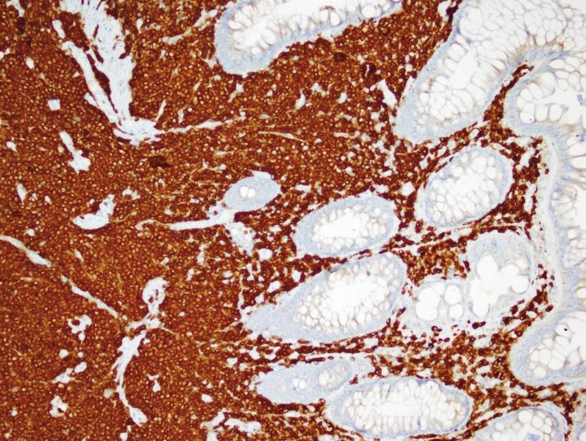 D1-positive atypical lymphocytes infiltrating the lamina propria  (e) Abdominal tomography.