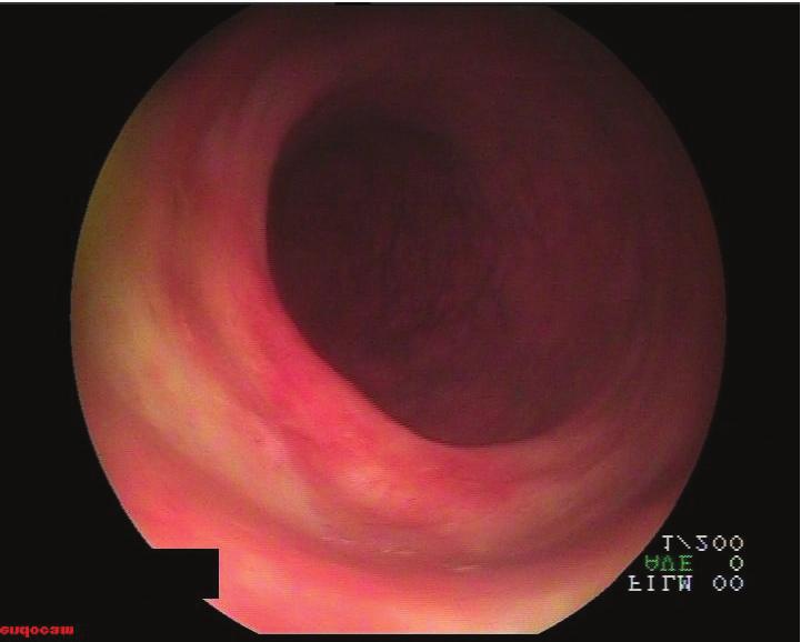 In the control colonoscopy, the mass on the distal of the rectum had disappeared (Figure 1(f)).