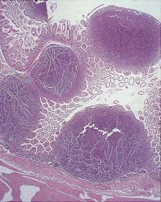 Polyposis Microscopical Infiltration Clinical