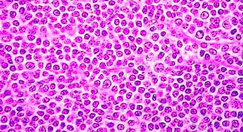 Chronic Lymphocytic Leukemia/ Small Lymphocytic Lymphoma Presence of > 5 x10 9