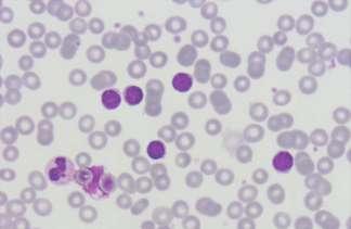 involvement and cytopenias allow for lower number of atypical lymphocytes SLL is