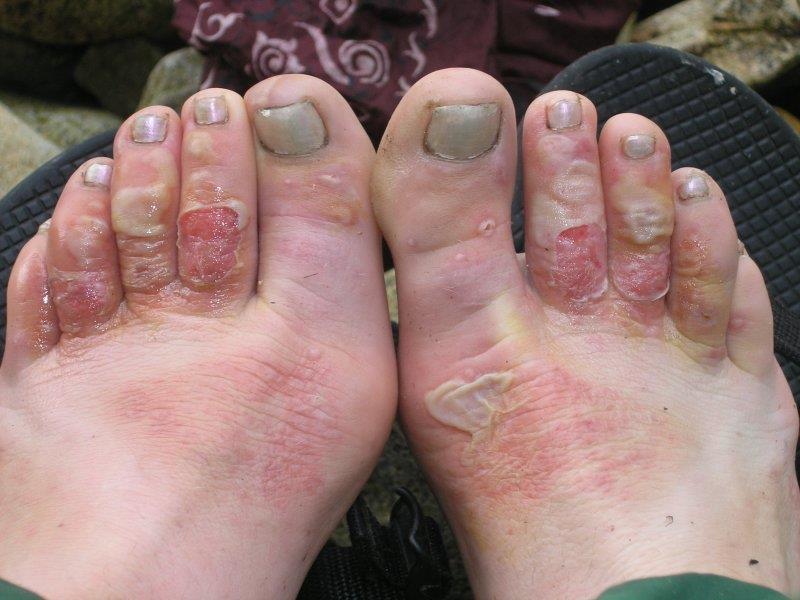 Foot problems Trench foot/