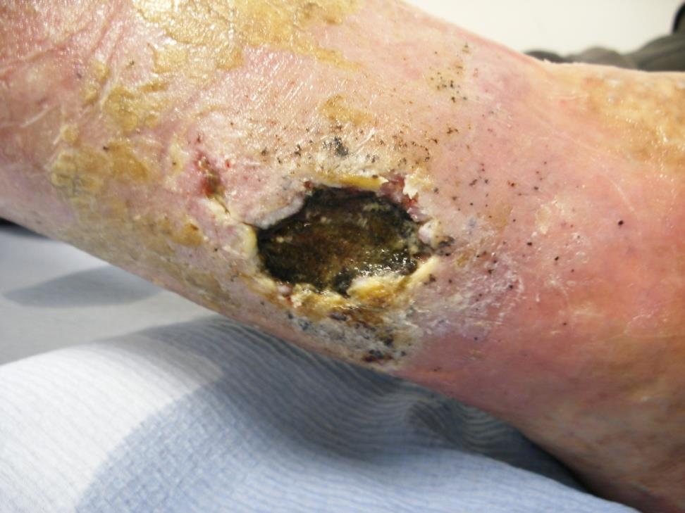 Leg ulcers Leg ulcers often caused by injecting injuries and poor