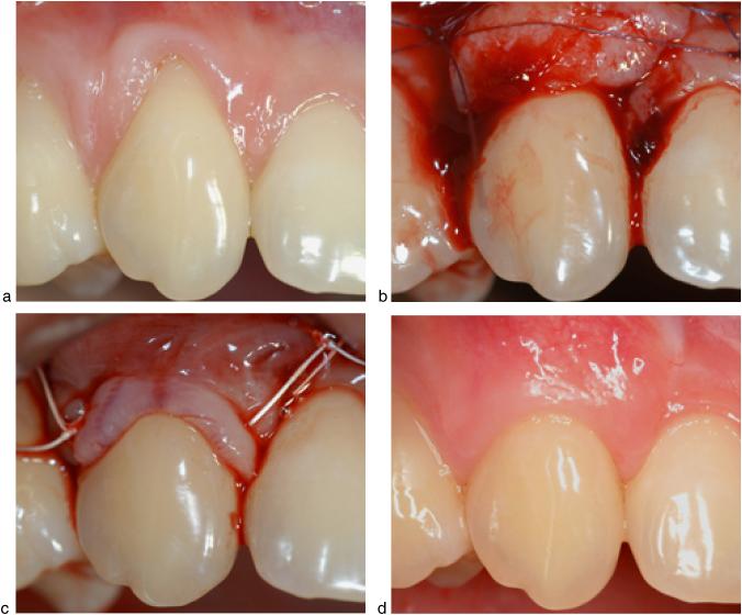 CAF versus CAF+CTG for coverage of single gingival recessions 73 Fig. 3. (a) Pre-operative image of an upper right cuspid presenting with a Miller Class I recession.