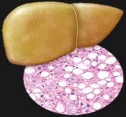 Calories Fatty Liver Store fat in liver Export fat to tissues