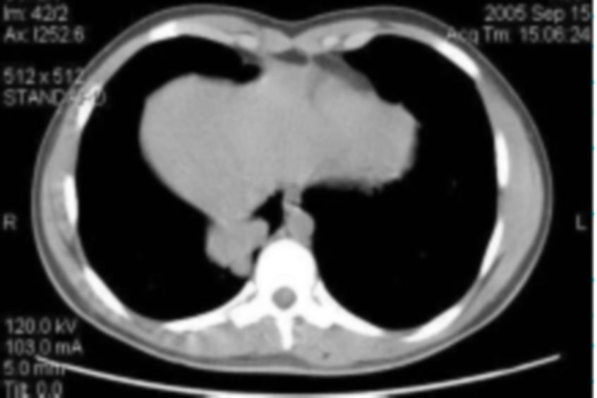 Case Report A 45-year-old man, with a history of heavy smoking, was admitted to our department complaining of acute right-sided chest pain of moderate intensity that was not related to breathing or