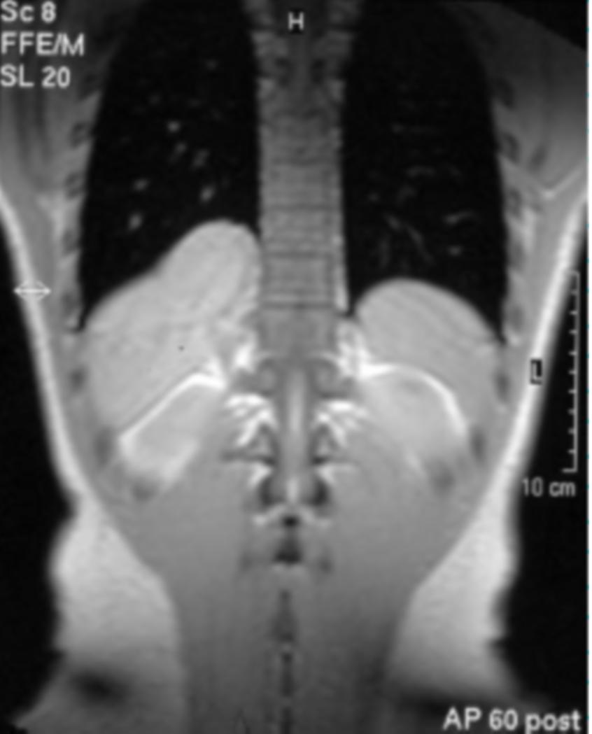 Right-sided Bochdalek Hernia Presenting as a Solitary Pulmonary Nodule Figure 3A. Coronal T1-weighted MRI reveals a portion of liver herniated through a defect in the posterior right hemidiaphragm.