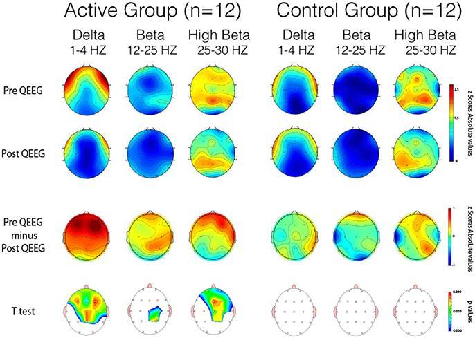 QEEG scans pre and post (1/3) Significant reductions in delta, beta & high beta waves in the active group (abnormally high in
