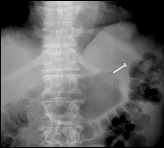 A Fig. 1. (A) Chest radiography showing a radio-opaque, 20-mm-long nail in the esophagus, at the T9-T10 vertebral level (black arrow). () Endoscopy showing abundant food residue in the stomach.