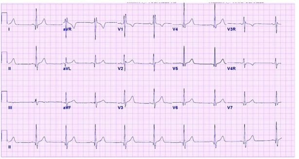 ECG demonstrates incomplete RBBB with rsr pattern in V1 and QRS duration of <120 ms.