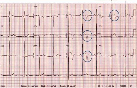 hypertrophy, J point elevation and convex ( domed ) ST segment elevation followed by T-wave inversion in V1 V4 From: International recommendations for electrocardiographic interpretation in athletes